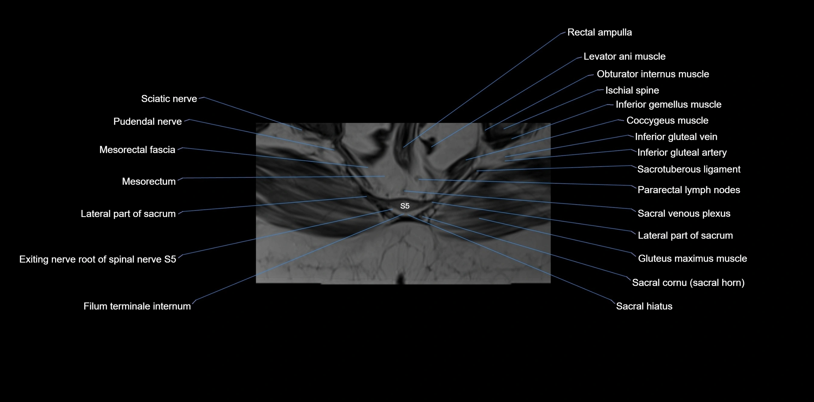 MRI sacrum, coccyx and sacroiliac joint axial cross sectional anatomy 3T  radiology  image-img-00001-00060.webp